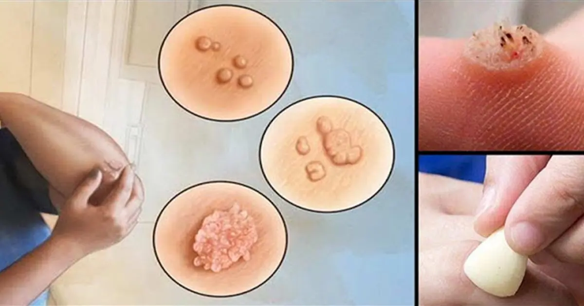 The most effective natural remedy to get rid of warts and calluses