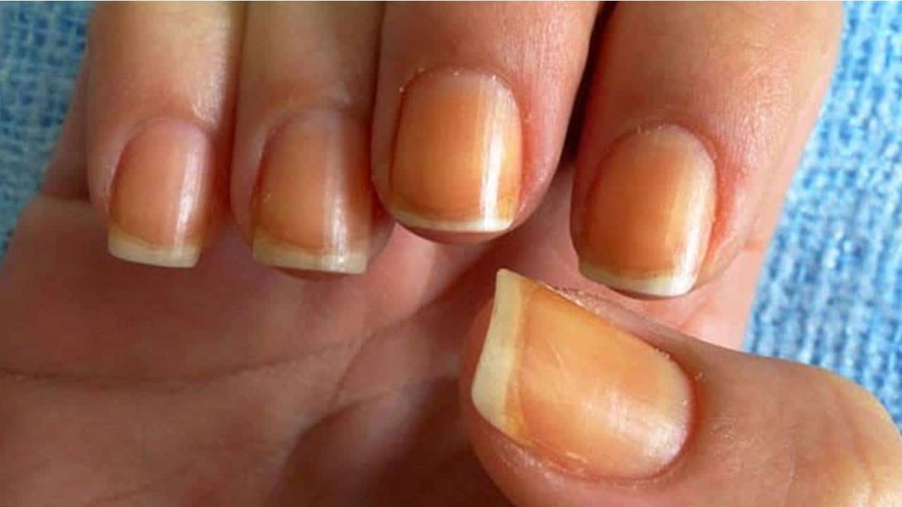 Por que as unhas podem ficar laranja?