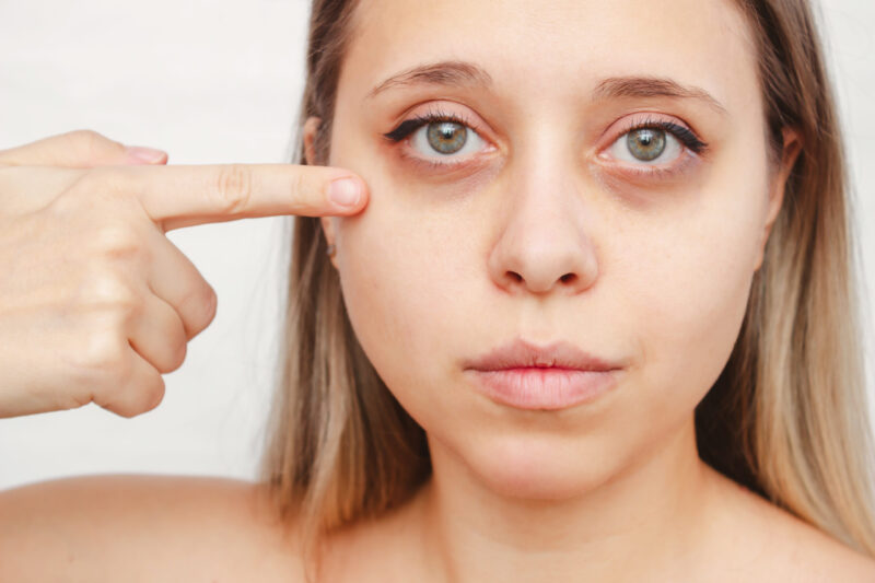 Antiolheiras: 4 dicas para acalmar os olhos