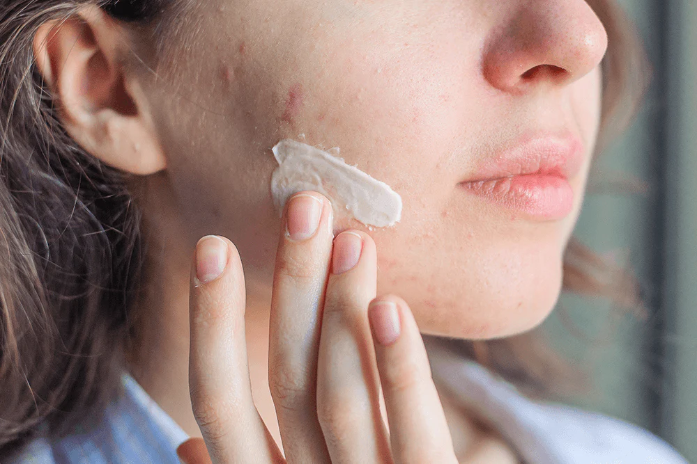 É verdade que a pasta de dente realmente elimina a acne?